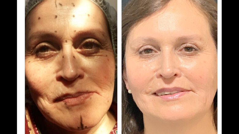 Foto 9. Control a los 8 meses del inicio del tratamiento que muestra los avances estéticos logrados. 