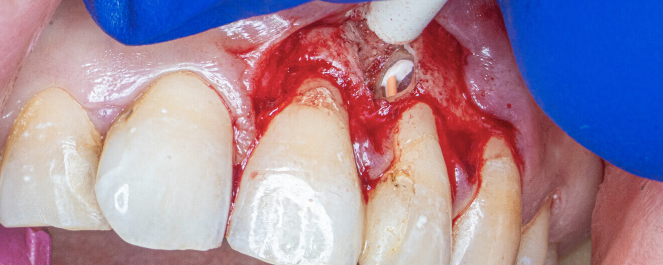 Fig. 3: Root canal obturation. Gutta-percha cone and sealer are visible.