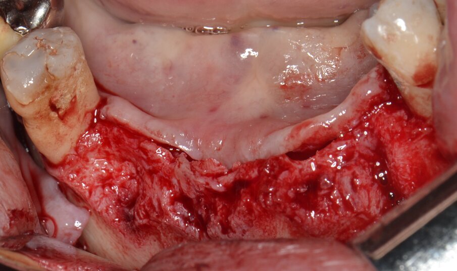 Fig. 5 - Scheletrizzazione dell’area edentula.