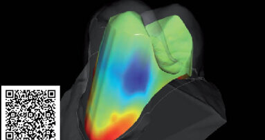 Vedci vyvíjajú softvér na zlepšenie nasadenia koruniek na zuby