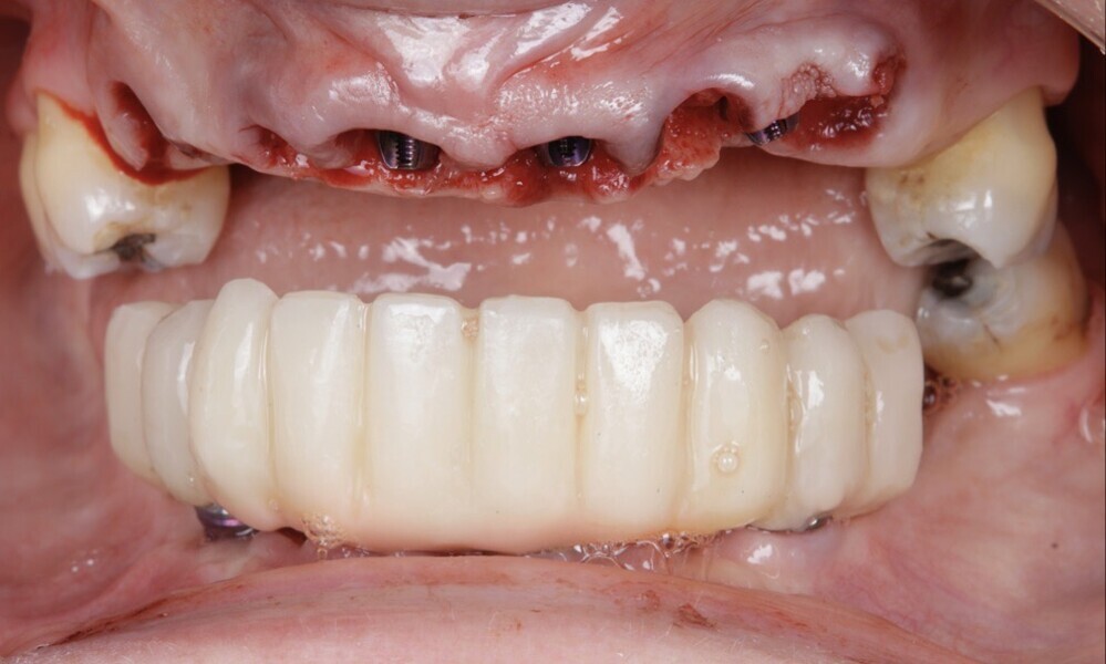 Figs. 56–60: The implants were placed, guided bone regeneration was performed using a xenograft and screw-retained abutments were placed.