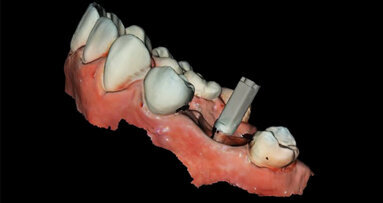Digitální workflow a aplikace PRF a ozonové terapie v orální rehabilitaci