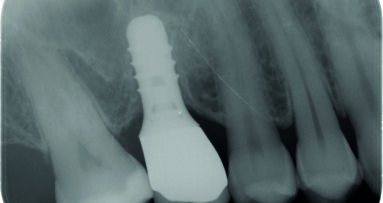 Grande rialzo del seno con impianto contestuale