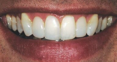 Le collage du banquier : lorsque le moins est un plus