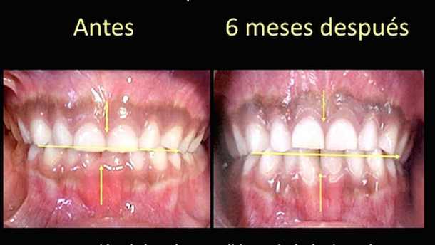 Evolución del tratamiento miofuncional postural con los sistemas de MRC (2)