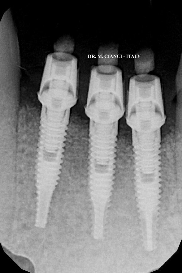 Fig. 15 - RX a 4 mesi dalla chirurgia.