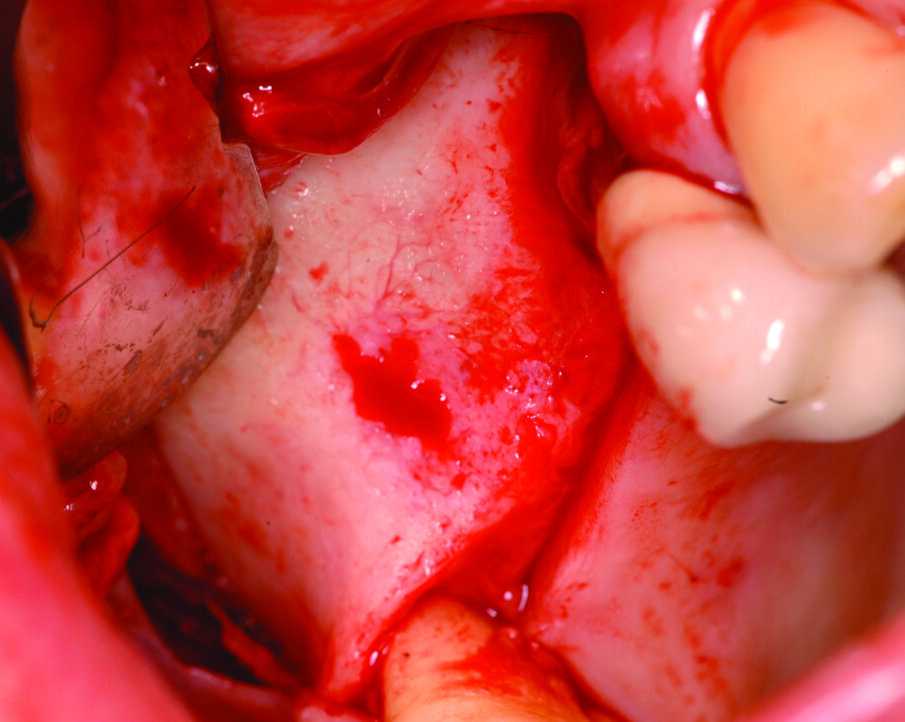Fig. 3_Disegno del lembo a tutto spessore con scarico mesiale e distale alla lacuna per una visione  intraoperatoria migliore.