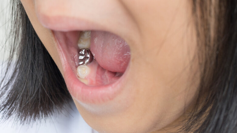 Crown and go: Kiwi study investigates pioneering method to treat caries