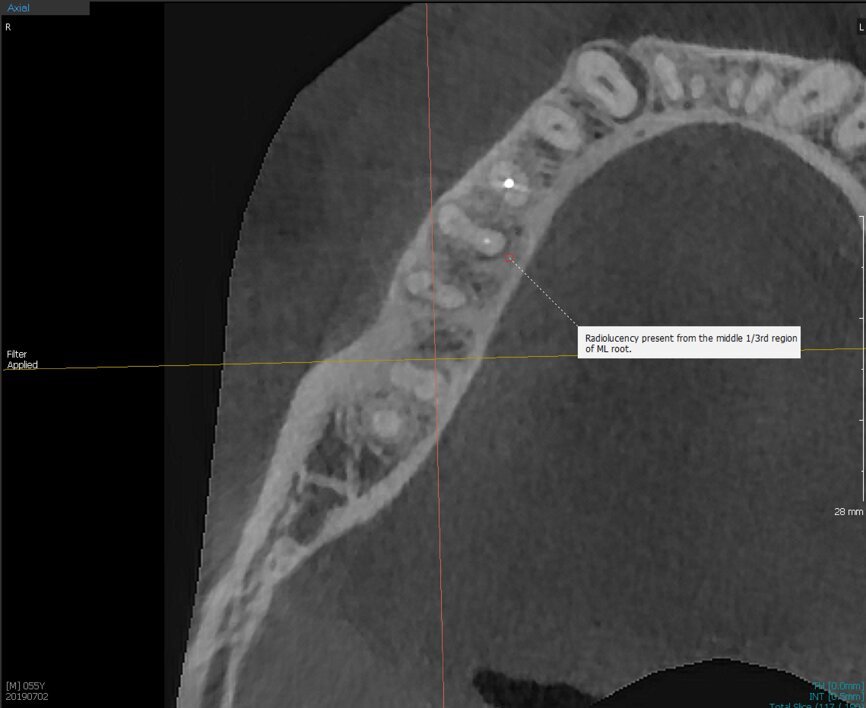 Fig.2a: Pre-op CBCT images of tooth #46: No obturation material in the distal and mesiobuccal canal (a); scanty obturation of the canals and breach of the floor of the pulp chamber, no obturation beyond a few millimetres down the orifice (b & c); radiolucency in the furcation area and periapical region of both roots (d -g).