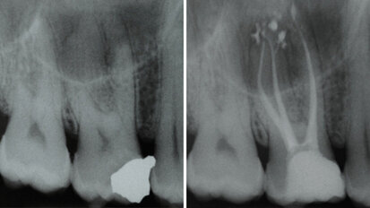 Vyplachování zahnutých kanálků