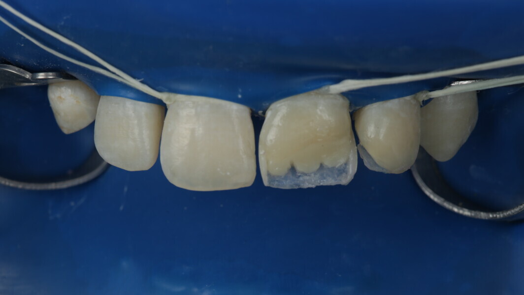 Fig 25: A2 Dentin was used for the inner layer and dentinal structures were created using 3 well-defined lobes.