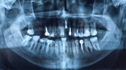 Menopause: Bisphosphonate begünstigen Verlust von Implantaten Menopause: Bisphosphonate begünstigen Verlust von Implantaten