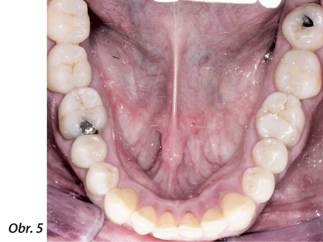 Obr. 1–5: Fotografi cká dokumentace počátečního stavu před parodontologickým ošetřením