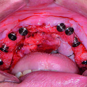 Fig-12-Coiffes-de-cicatrisation-mises-en-place-300x300-