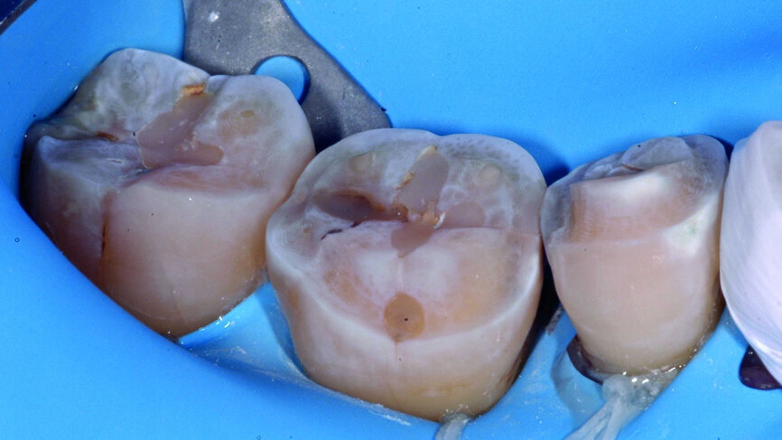 Fig. 14 : Préparations mordançées avant application de l’adhésif ExciTE non polymérisé. |