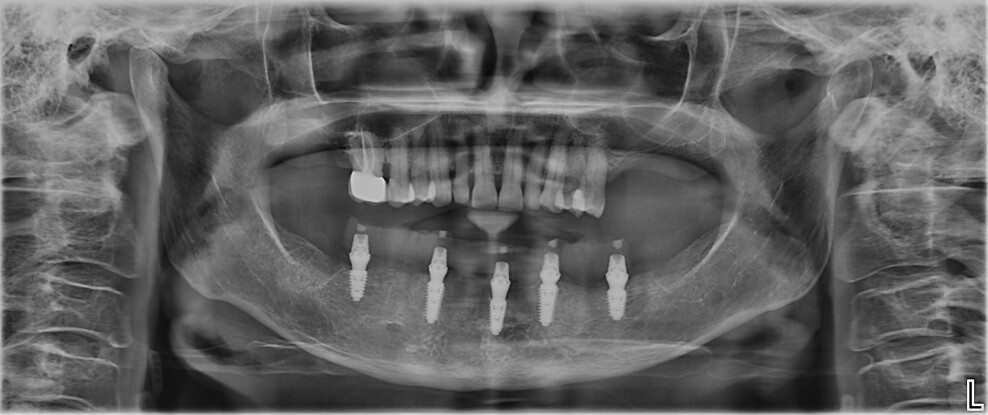 Fig. 9: Panoramic radiograph after five months of healing.