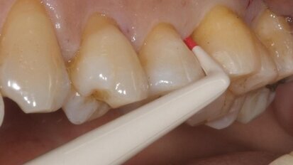 Biomateriali biomimetici nella rigenerazione dei difetti parodontali