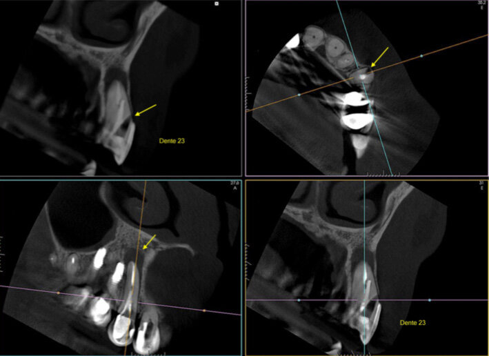 Fig. 1: A cone beam computed tomography was performed for diagnosis and to establish a treatment plan. (Photos/Provided by Renato Interliche, Douglas Giordani Negreiros Cortez and Clauber Romagnoli)