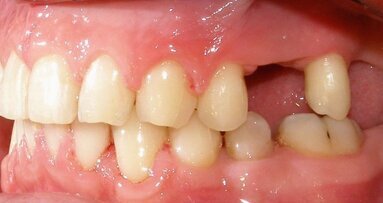 Le mouvement dentaire pourrait être une alternative aux greffes osseuses