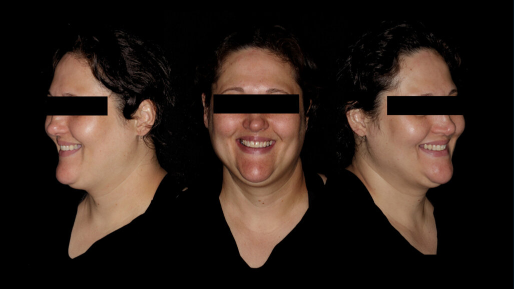 One-year follow-up of Straumann Fast Molar Solution in bilateral maxillary premolars