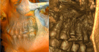 Maxillary sinus and root canal therapy complications