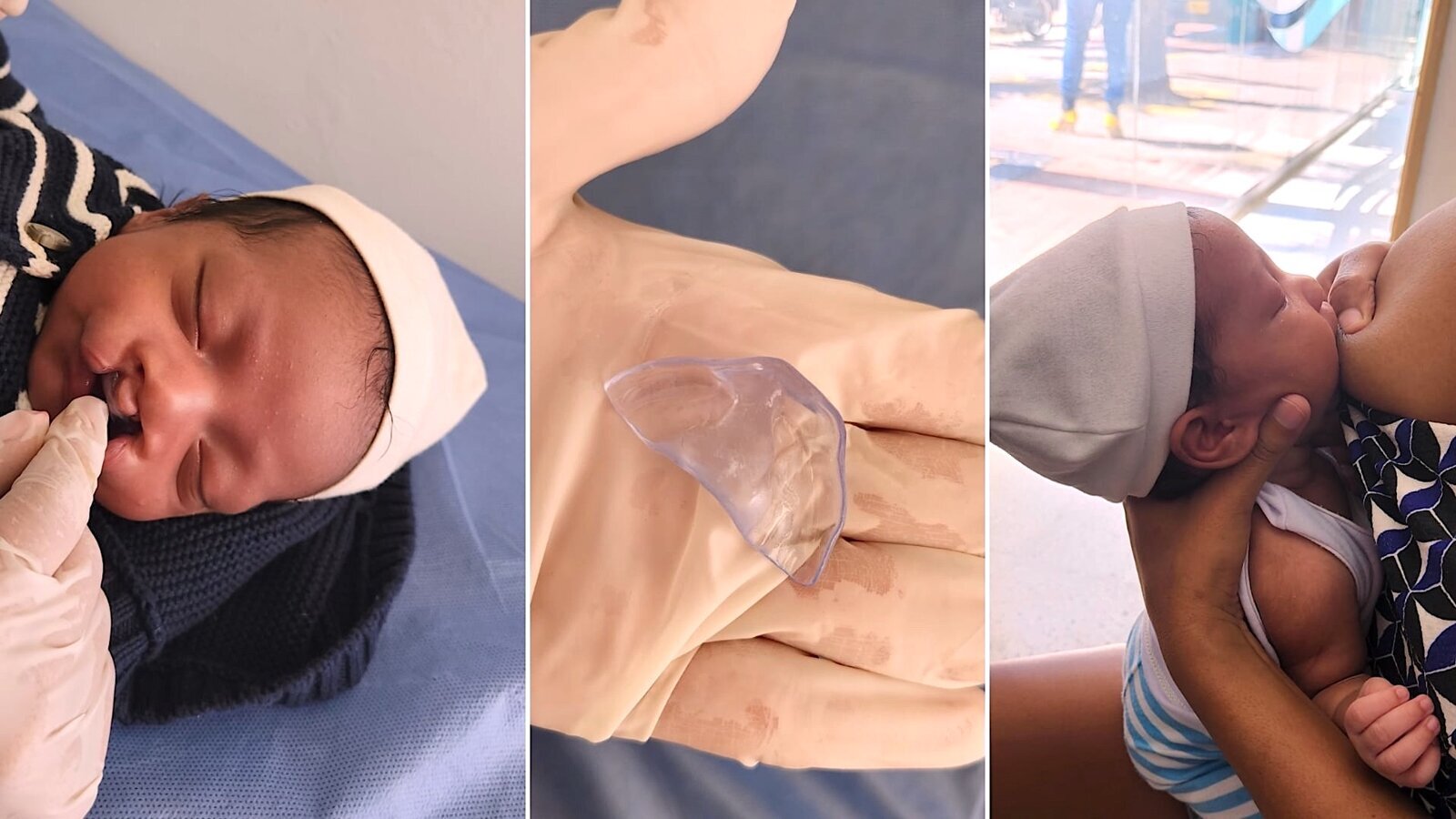 Rehabilitación de bebés con labio y paladar fisurado