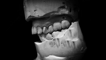 Cast mounting using MaxAlign: The clinical component
