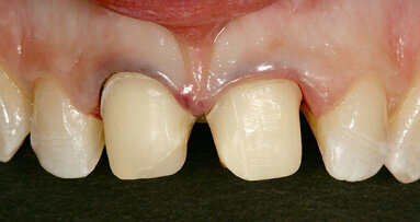 Inovativní postup adhezivního upevňování