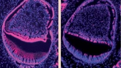 Komórki macierzyste układu krwiotwórczego –  wykorzystanie zębów mądrości