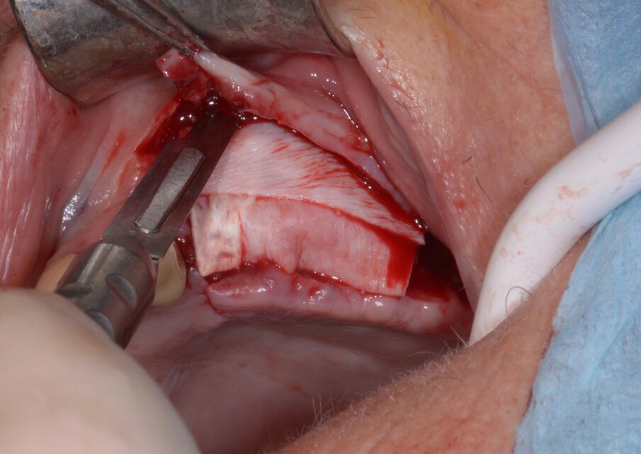 Fig. 11 - Incisioni di rilascio periostali.