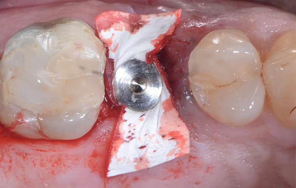 Fig. 21 : Mise en place d’une membrane de collagène et suture. 