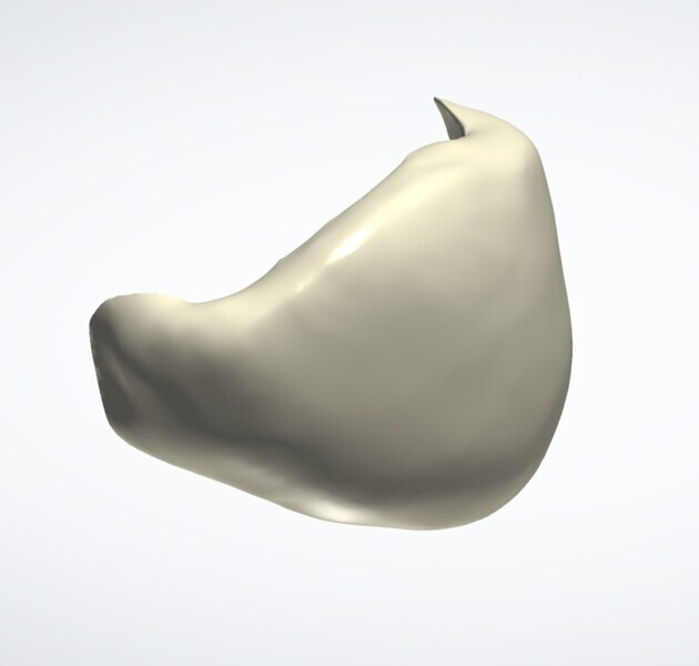 Fig. 9: Veneer, facial aspect.