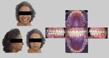 El dispositivo infalible para evitar el ronquido y la apnea de sueño