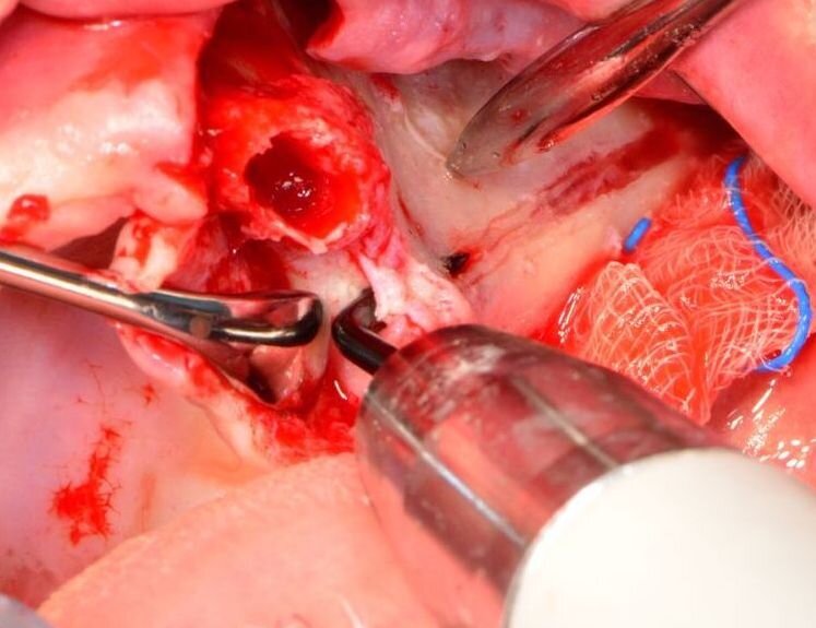 Fig. 8 - Con lo strumento a punta ES052XGT si inizia la preparazione crestale/palatina, cioè l’ingresso dell’impianto zigomatico.