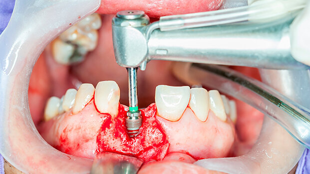 Impianti oggi: quali, da chi e quando?