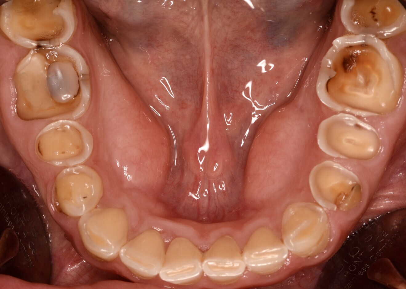 Fig. 1e: Almost complete loss of the occlusal relief in the lower jaw.