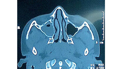 Patologías del seno maxilar Patologías del seno maxilar