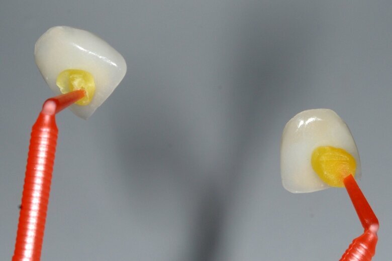 Fig. 18 Veneers secured to a placement instrument before definitive cementation.