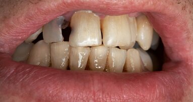 Verbindung zwischen Genen und Karies belegt