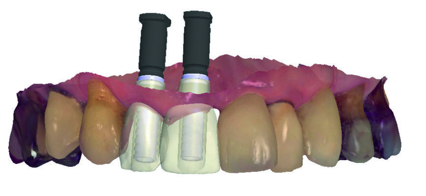 Figs. 5a et b : Design des couronnes provisoires virtuelles et leur piliers provisoires en transparence. 