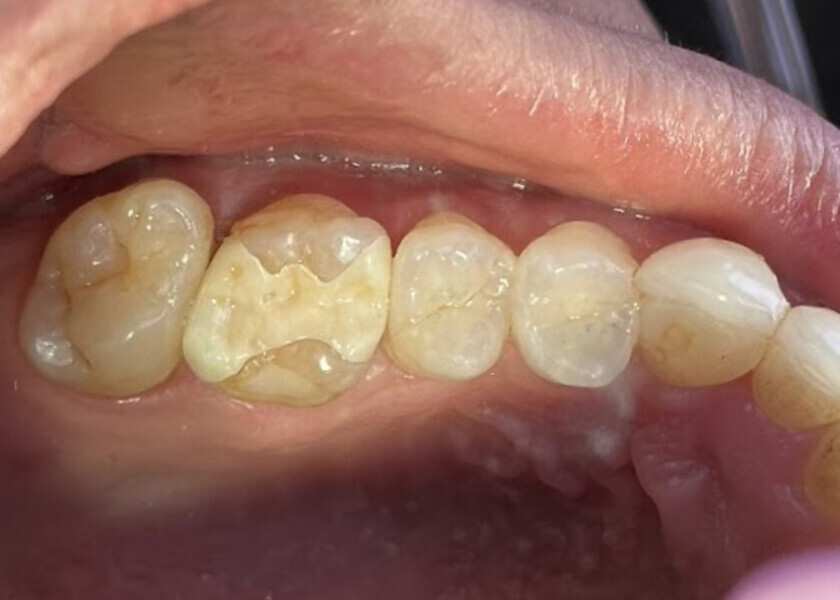 Fig. 15: Try-in of the inlay to verify fit marginally and proximally