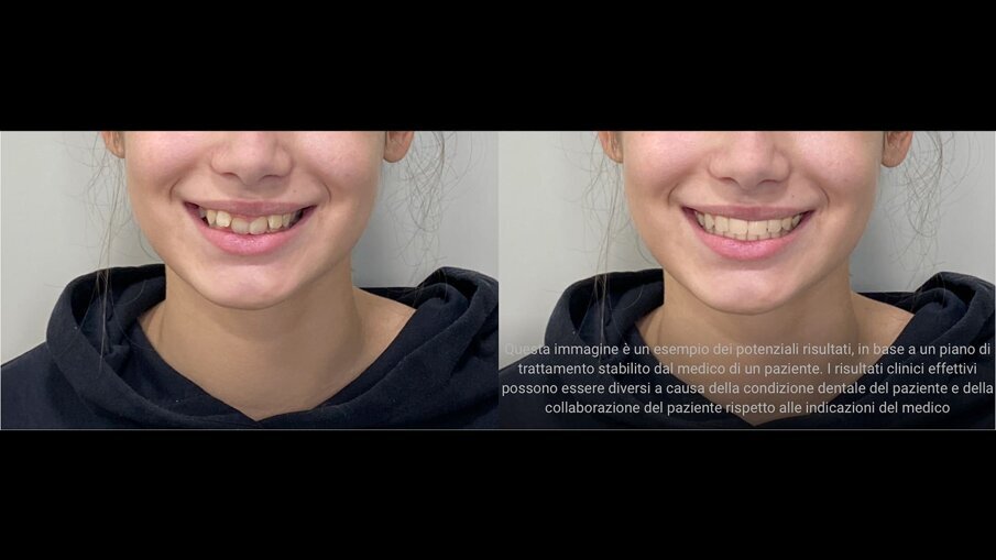 Fig. 13_ClinCheck In-Face Visualization.