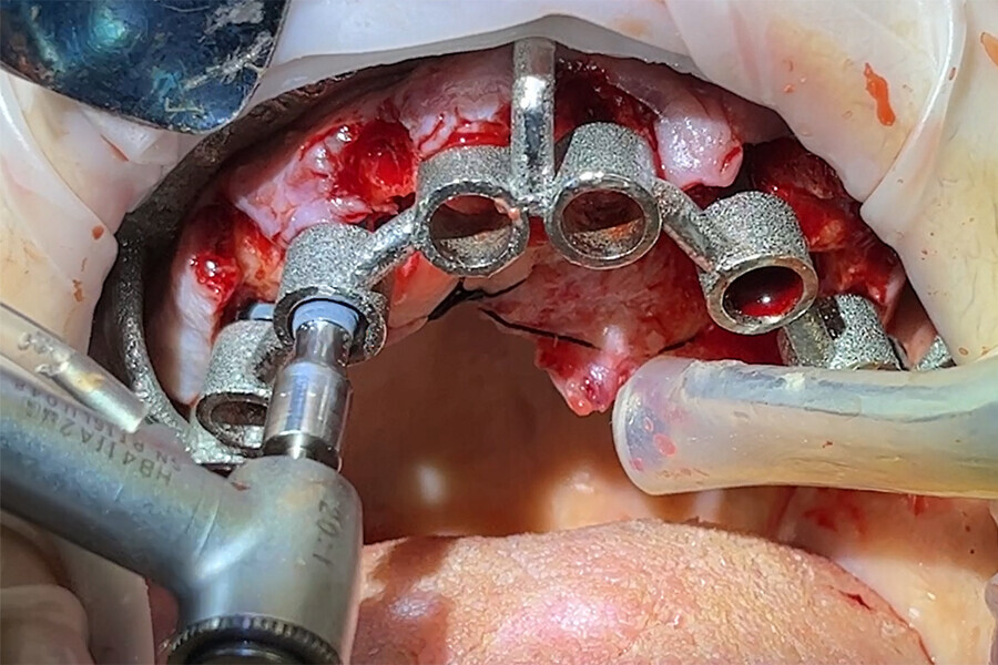 Fig. 5a: Chrome osteotomy drilling guide used for full-template guidance.