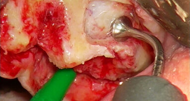 Piezochirurgie je metodou volby