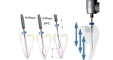 Endodontický restart: debridement s adaptivním jádrem a finální dezinfekce