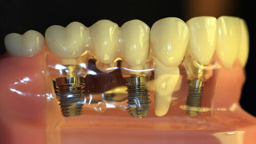 Η αποτυχία των εμφυτευμάτων μπορεί να σχετίζεται με τη χρήση διφωσφονικών