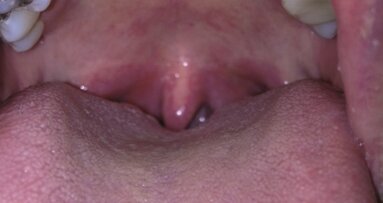 Laserowe leczenie chrapania i bezdechu sennego