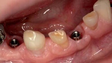 Kompromisowe leczenie implantoprotetyczne i zachowawcze w przebiegu dysplazji ektodermalnej