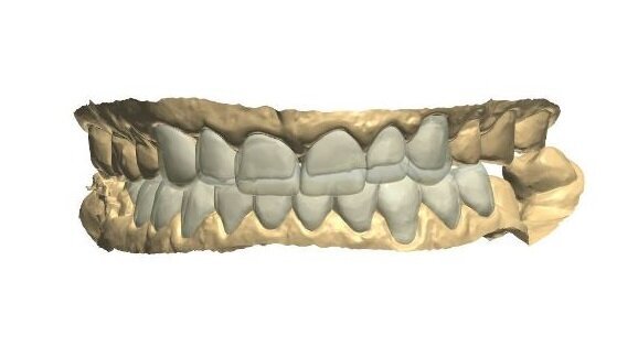 Kompleksowa rehabilitacja zwarcia z wykorzystaniem skanera wewnątrzustnego