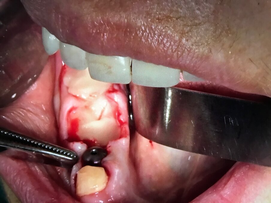 Fig. 13 - Fase 3: A-PRF utilizzato come membrana di contenimento. Non è necessario elevare lembi vestibolari e linguali per accollare i margini gengivali.